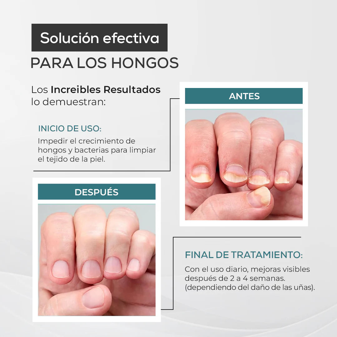 My Finger Solution – Tratamiento Antihongos