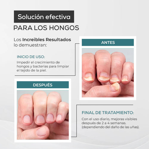 My Finger Solution – Tratamiento Antihongos