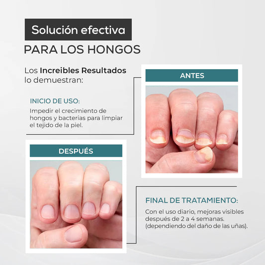 My Finger Solution – Tratamiento Antihongos